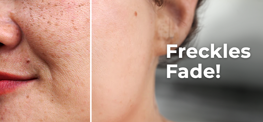 Freckles Treatment